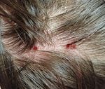The scalp wounds Kirsten Mathisen received from an aggressive barred owl.