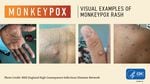 Monkeypox is spreading in Oregon, with 32 confirmed and suspected cases up from just six last month. Recognizing symptoms early, limiting skin-to-skin contact with others, and seeking vaccination if you’re at highest risk, can help protect your health.