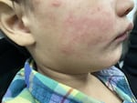 An undated image provided by the U.S. Centers for Disease Control and Prevention shows a child with a characteristic rash associated with measles.