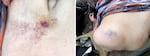 Bruising on the chest, left, and shoulder of Katherine Hoffman. Witnesses told police that Hoffman was slammed to the ground and struck multiple times with a baton by guards in an exchange in Oct. 7, 2020.