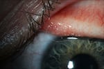 A transparent eye worm on the surface of a patient's conjunctiva.
\