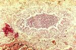 Bronchiolar plugging in neonate with pertussis pneumonia.