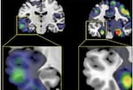 This brain scan released by University of Washington Medicine shows atrophy in the lateral temporal lobe (left) of a participant in AD-Language subgroup and atrophy in the medial temporal lobe (right) of a participant in AD-Memory subgroup.