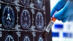 The first Alzheimer’s blood test cleared by the Food And Drug Administration is set to make diagnosis more accessible and accurate — and change the way doctors treat the disease.
