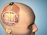 This illustration shows how the thin film of sensors could be applied to the brain before surgery, 