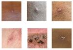 six small squares display images of pustules on different skin types