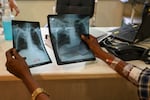 In this picture taken on March 22, 2022, Gautam Kamble, who is diagnosed with tuberculosis, holds chest x-rays during a routine consultation with a doctor at the Médecins Sans Frontières (MSF) clinic, which treats people with drug-resistant tuberculosis, in Mumbai. - When Covid-19 ripped through India in 2020-21, several million people are thought to have died. Desperate efforts to stem the pandemic hurt the battle against another huge killer: tuberculosis. - TO GO WITH India-Health-tuberculosis-vaccine,FOCUS by Glenda KWEK 