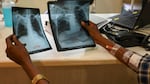 In this picture taken on March 22, 2022, Gautam Kamble, who is diagnosed with tuberculosis, holds chest x-rays during a routine consultation with a doctor at the Médecins Sans Frontières (MSF) clinic, which treats people with drug-resistant tuberculosis, in Mumbai. - When Covid-19 ripped through India in 2020-21, several million people are thought to have died. Desperate efforts to stem the pandemic hurt the battle against another huge killer: tuberculosis. - TO GO WITH India-Health-tuberculosis-vaccine,FOCUS by Glenda KWEK