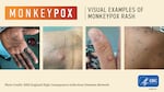 Monkeypox is spreading in Oregon, with 32 confirmed and suspected cases up from just six last month. Recognizing symptoms early, limiting skin-to-skin contact with others, and seeking vaccination if you’re at highest risk, can help protect your health.