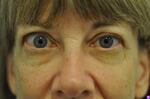 Thyroid Eye Disease causes the eyes to bulge out and the lids to be drawn back. Untreated it can lead to blindness.