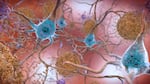 Beta amyloid plaques, shown in brown, and tau tangles, in blue, are considered the key markers in the brain of Alzheimer's disease. 