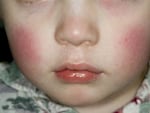 A parvovirus B19 infection can cause a facial rash in children, which is why the disease caused by the virus is sometimes called "slapped-cheek disease."