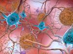 This illustration made available by the National Institute on Aging/National Institutes of Health depicts cells in an Alzheimer's-affected brain. An experimental drug modestly slowed the brain disease's progression, researchers reported Tuesday.