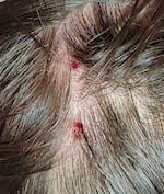 The scalp injuries that Kirsten Mathisen received from an aggressive barred owl.