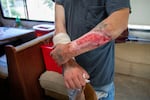 A man came in to the van with severe wounds on his arms from using the drug xylazine, also known as Tranq.