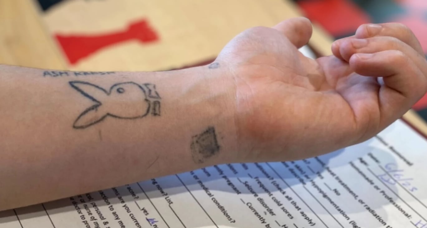 Landon's tattoos before they began the removal process.