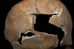 This hole was made in a Bronze Age man's skull shortly before he died, archaeologists say, based on several clues. It's the result of a surgical procedure called a trephination.