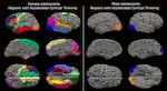 New research from the University of Washington’s Institute for Learning & Brain Sciences, or I-LABS, found the COVID-19 pandemic lockdowns resulted in unusually accelerated brain maturation in adolescents. This maturation was more pronounced in females, as seen on the left.