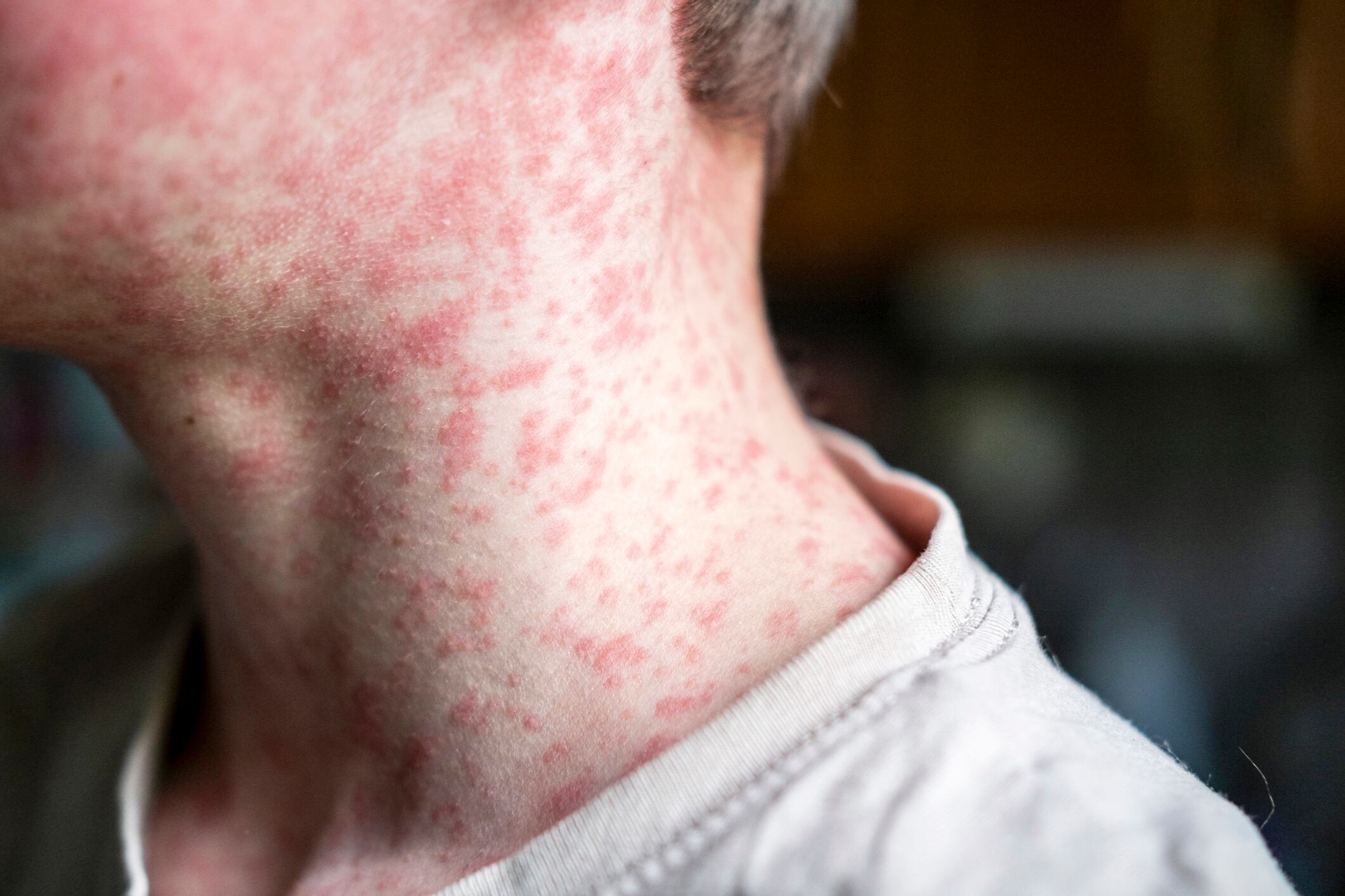 Measles spreads easily. It's one of the world's most contagious diseases.
