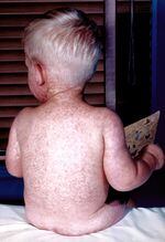 The third day of a measles rash on a baby boy back in 1963.
